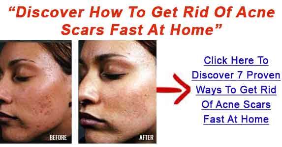 ... Quickly | How To Treat Acne Scars Fast - Get Rid Of Acne Scars At Home